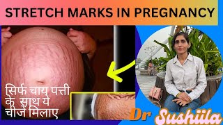 Remove Stretch Marks at Home  Pregnancy Ke Stretch Marks Hataye Naturally  stretchmarks [upl. by Drareg934]