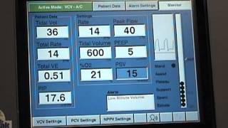 Respironics Esprit Ventilator with Blom Tracheostomy Tube [upl. by Adlih906]