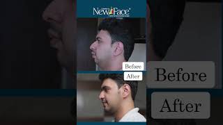 Obstructive Sleep Apnoea Correction  Jaw Surgery  Dr Mathew PC shorts [upl. by Amy367]