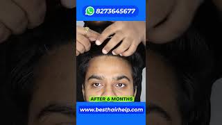 3 Hair Transplant Results Of 1000 2000 And 3000 Grafts In 1 Minute 🔥🔥🔥 hairtransplantresults [upl. by Nniroc]