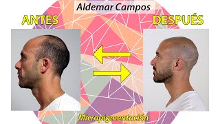 Micropigmentación Capilar ENGLISH SUB ¿Soluciones para la alopecia [upl. by Schramke]