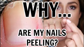 STOP The Peeling Of Your Nails [upl. by Annyl]