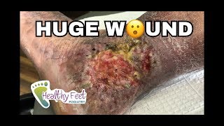 Huge Wound on Foot and Leg [upl. by Lanti491]