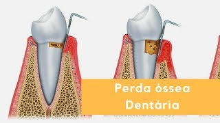 Perda óssea Dentária [upl. by Enelia]