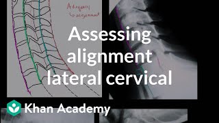 Assessing alignment of the lateral cervical spine neck Xray  Heatlh amp Medicine  Khan Academy [upl. by Assirialc304]