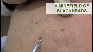 A Minefield of Blackheads  Dr Derm [upl. by Aitrop881]