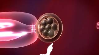 Preimplantation Genetic Diagnosis PGD [upl. by Ihsakat]