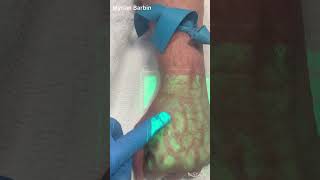 How To Start An IV with a Vein Finder medicalimaging veinaccess veinfinder ivcatheter [upl. by Anatnahs85]