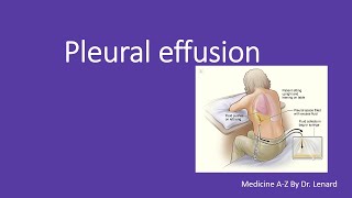 Pleural Effusion causes pleural fluids analysis thoracentesis Exudative and transudative [upl. by Josephine]