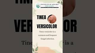 TINEA CORPORIS SYMPTOMS amp TREATMENT [upl. by Toulon18]