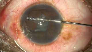 BHEX ring use during retinal surgery [upl. by Im923]