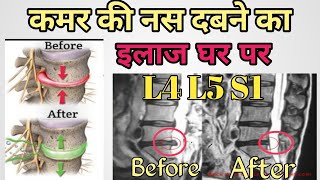 L4 L5 S1 Nerve root Compression Exercises  Buldging Disc Exercises  Herniated disc  in hindi [upl. by Orin622]