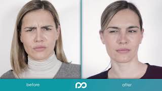 What does Botox do to your face Brilliant distinctions [upl. by Bernhard]