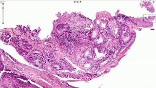 Barrett Esophagus  Histopathology [upl. by Pontias]