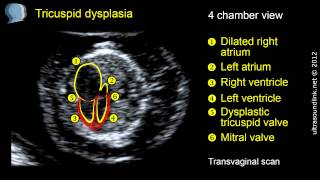 Tricuspid regurgitation TR in fetus tricuspid dysplasia at 12 week scan [upl. by Underwood]