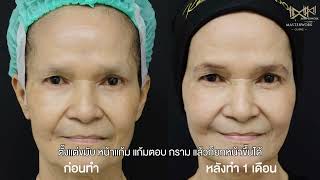 Sculptra VS Radiesse ต่างกันอย่างไร [upl. by Rufina]