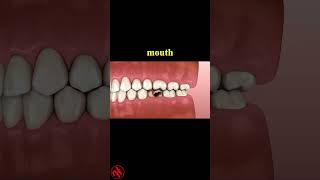 Losing Molar Tooth 3D Animation dental health dentalwellness [upl. by Eltsirk]