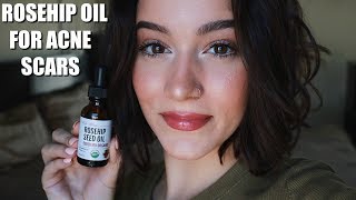 TRYING ROSEHIP OIL FOR A MONTH FOR ACNE SCARS [upl. by Nafets267]