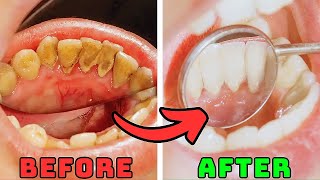 Top 5 Natural Remedies to Remove Plaque and Tartar From Teeth [upl. by Mahala]