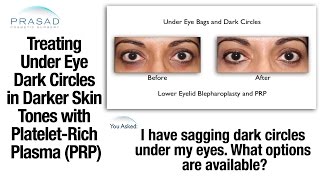 Treating Under Eye Dark Circles in Ethnic Skin Tones with PlateletRich Plasma PRP [upl. by Ludmilla]