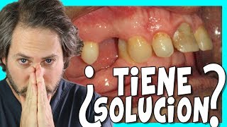 👉BRACKETS👈para dientes superiores ADELANTADOS tratamiento CLASE 2 ORTODONCIA ANTES Y DESPUES [upl. by Debora]