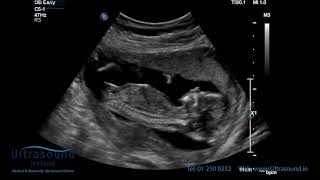 Scan of the Week 15 Weeks Pregnant The Advanced Early Ultrasound [upl. by Weismann922]