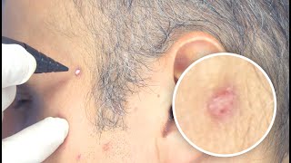 Freezpen  Lesion treatment on the face [upl. by Worrad]