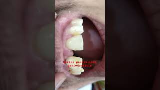 Severe generalized periodontitis causing spacing in teeth dentaltreatmentviral videoperiodontitis [upl. by Oag513]