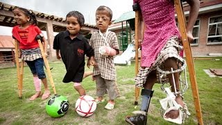 Helping Children Walk Run amp Thrive Child Amputees amp Children with Limb Disabilities [upl. by Nemrac]