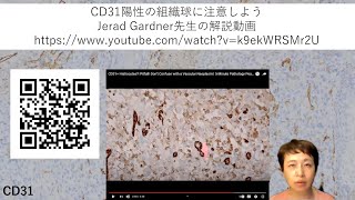 CD31染色の解釈の注意点 [upl. by Kcam226]