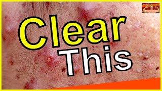 Acne on TRT  EXPERT Dermatologist Advice you NEED to Learn  Back Acne  Steroid Acne [upl. by Kcirednek]