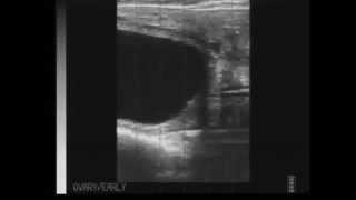 Ultrasound Quiz  Pregnant or Open questions [upl. by Mahgem]