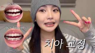 교정 4개월차 교린이의 치아 교정 후기😁  계기 병원 가격 통증 음식 관리법 [upl. by Elurd]