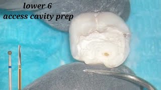 access Cavity for Badly Decayed lower molar [upl. by Anayia]