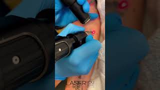 Picosure Laser Tattoo Removal Your Path to a Blank Canvas  Erasing Ink [upl. by Pooh]