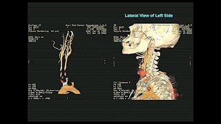 Radiology of the Neck  with optional subtitles [upl. by Katey]