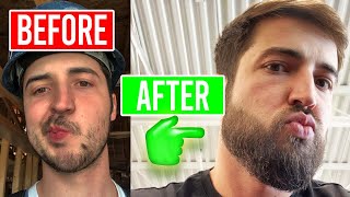 Ultimate Beard Growth Guide Minoxidil amp MicroNeedling [upl. by Annunciata348]