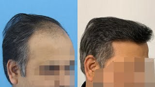 Hair Transplant Result at Eugenix by 9 months [upl. by Cherry]