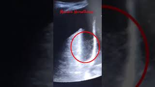 Massive Hemothorax  POCUS ICT criticalcaremedicine medicalspeciality medicine [upl. by Pamella]