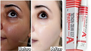 Tretinoin mistakes that ruined my skin 😫 tretinoin skincare beauty Not Really [upl. by Nilyad]