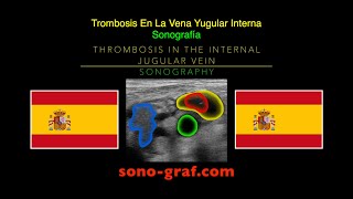 Sonografía  Trombosis En La Vena Yugular Interna [upl. by Schnur]