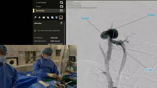 Pulmonary arteriovenous malformation embolization with plugs and coils 폐동정맥기형색전술 [upl. by Stieglitz]