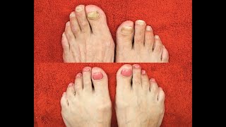 The most UNBELIEVABLE pedicure  toenail transformation video youll see today [upl. by Judon33]