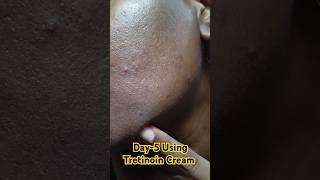 Day5 Using Tretinoin Cream 0025 cream viralvideo skincare tretinoin youtubeshorts shorts [upl. by Ytissahc]