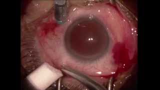 Vitrectomie pelage pour membrane epimaculaire  Vitrectomy for epiretinal membrane [upl. by Negam]