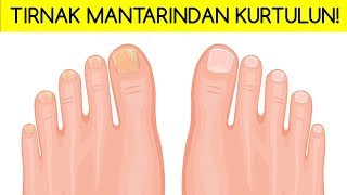 TIRNAK MANTARINDAN KURTULMANIN 5 DOĞAL YÖNTEMİ [upl. by Eetnuahs707]