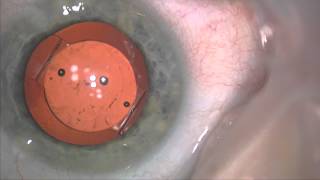 Dropless cataract surgery using triamcinolone moxifloxacin and vancomycin [upl. by Perron]