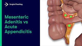 Mesenteric Adenitis vs Appendicitis  How to tell the difference [upl. by Ybrik]