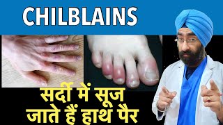 Chilblains  सर्दी में सूज जाते हैं हाथ पैर  Swollen hands and fingers in Winter  DrEducation [upl. by Indnahc523]