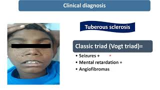 Tuberous Sclerosis  Spot Diagnosis  8  Pediatrics [upl. by Crandell814]